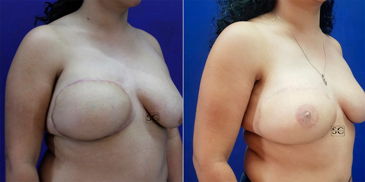 Reconstrucción del complejo areola-pezón.