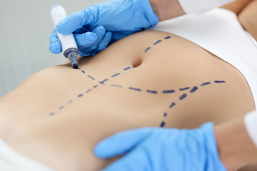 Lipoescultura Abdominoplastía