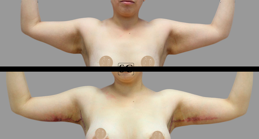 Braquiplastía