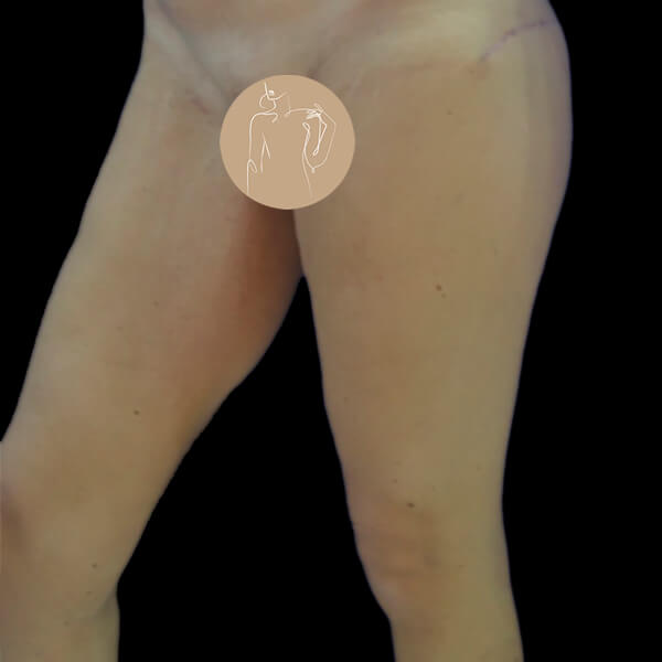Después Estiliza-tus-muslos