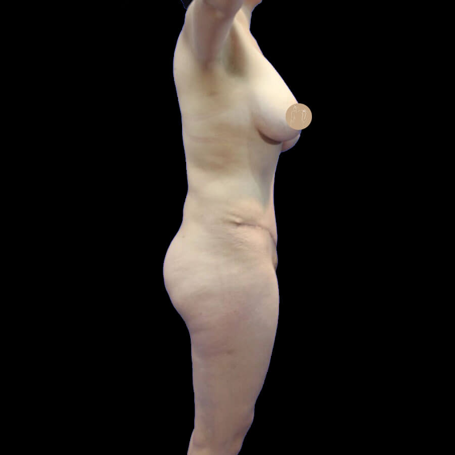 Después Lipoescultura