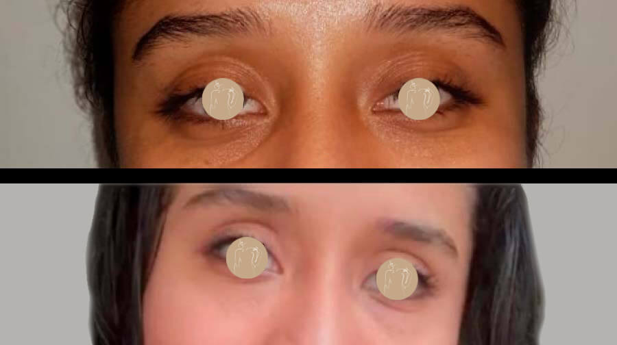 Despigmenta y rellena ojeras