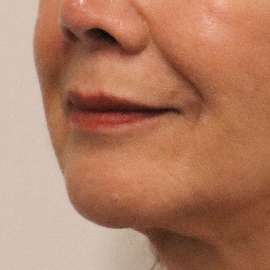 facelift-despues